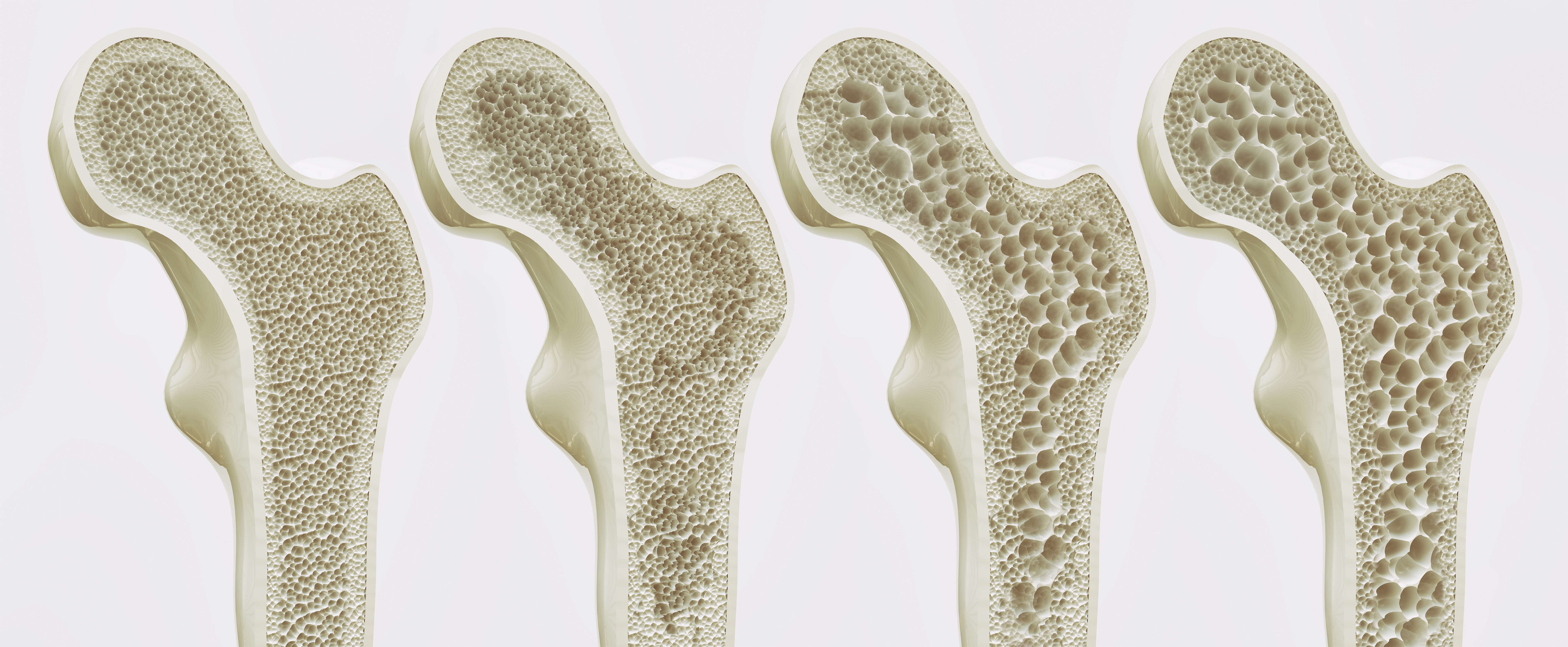 Плотный увеличиваться. Остеопороз тазобедренного сустава. Остеопороз кость. Кальций в костной ткани. Кость при остеопорозе.